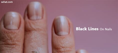 black lining on nails|black lines in nails reason.